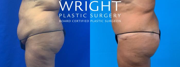 Before & After Tummy Tuck Case 156 Left Side View in Little Rock, Arkansas