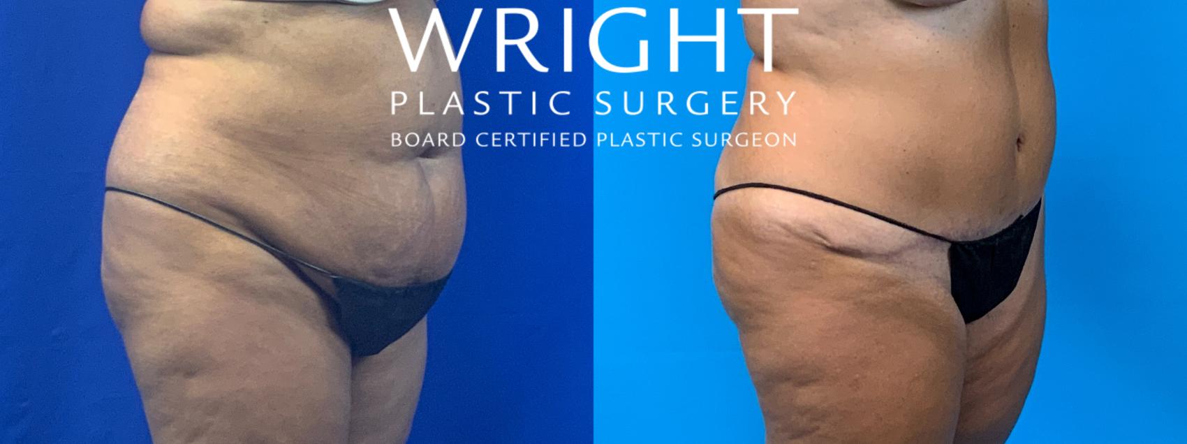 Before & After Tummy Tuck Case 156 Right Oblique View in Little Rock, Arkansas
