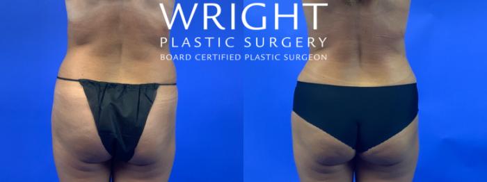 Before & After Liposuction Case 162 Back View in Little Rock, Arkansas