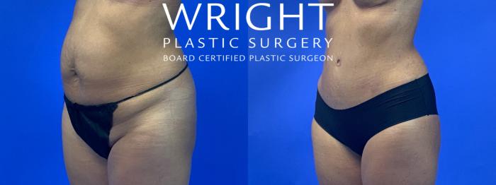 Before & After Tummy Tuck Case 162 Left Oblique View in Little Rock, Arkansas
