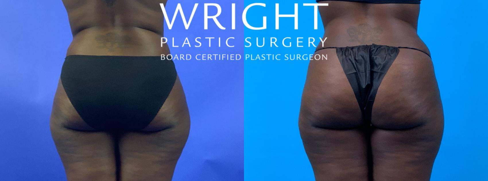 Before & After Tummy Tuck Case 172 Back View in Little Rock, Arkansas