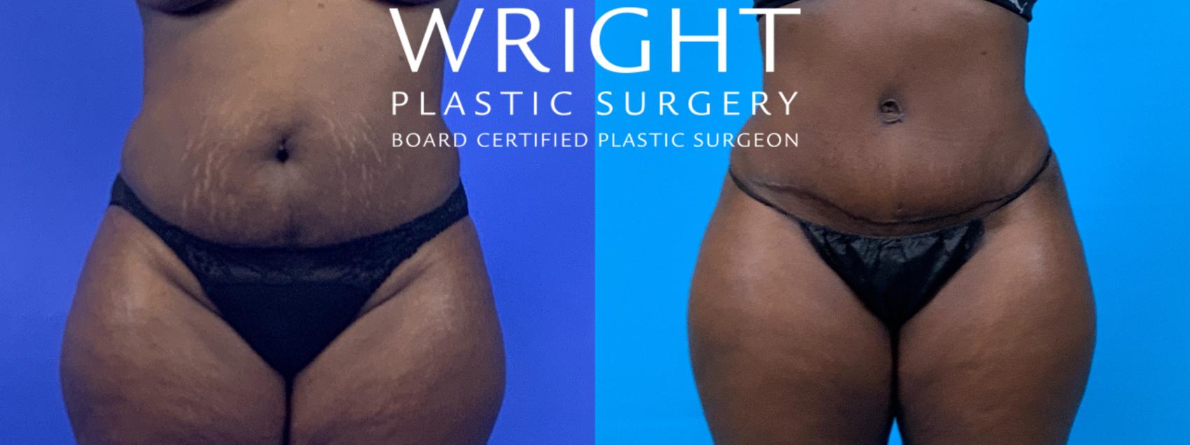 Before & After Liposuction Case 172 Front View in Little Rock, Arkansas