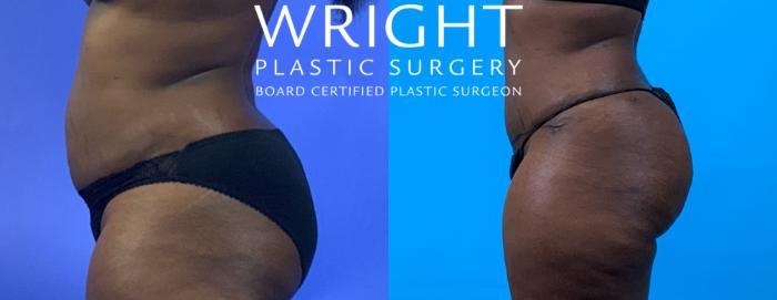 Before & After Tummy Tuck Case 172 Left Side View in Little Rock, Arkansas