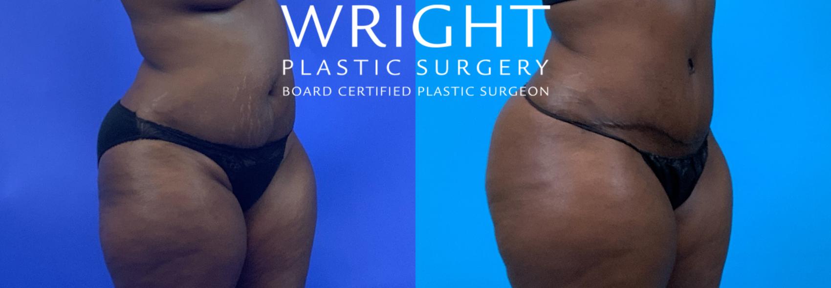 Before & After Tummy Tuck Case 172 Right Oblique View in Little Rock, Arkansas