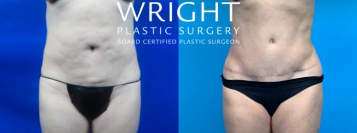 Before & After Tummy Tuck Case 180 Front View in Little Rock, Arkansas