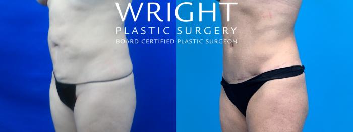 Before & After Tummy Tuck Case 180 Left Oblique View in Little Rock, Arkansas