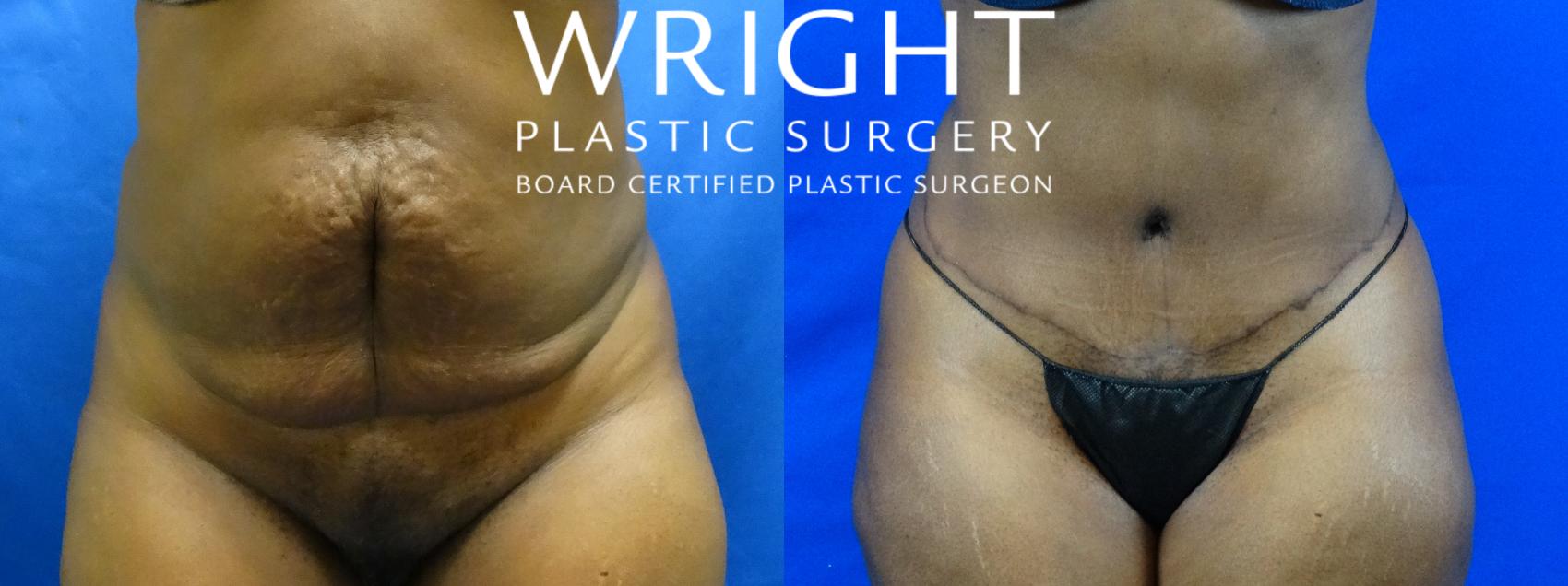 Liposuction for Little Rock & Fayetteville, AR