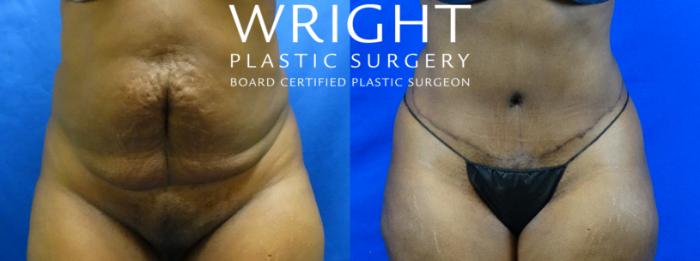 Before & After Tummy Tuck Case 19 Front View in Little Rock, Arkansas