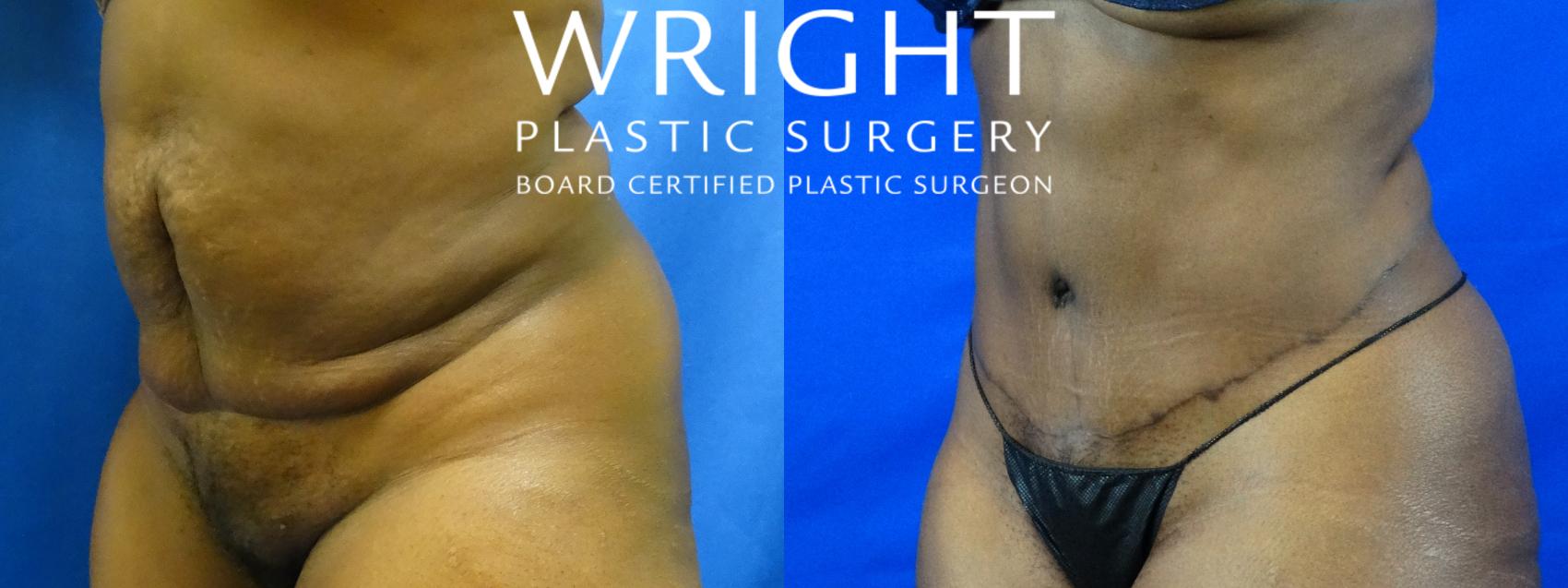 Before & After Tummy Tuck Case 19 Left Oblique View in Little Rock, Arkansas