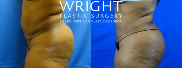 Before & After Tummy Tuck Case 19 Left Side View in Little Rock, Arkansas