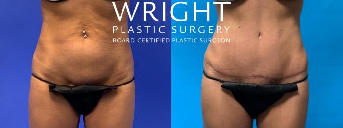 Before & After Tummy Tuck Case 191 Front View in Little Rock, Arkansas