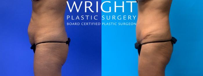 Before & After Tummy Tuck Case 191 Left Side View in Little Rock, Arkansas