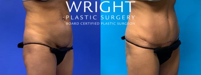 Before & After Liposuction Case 191 Right Oblique View in Little Rock, Arkansas