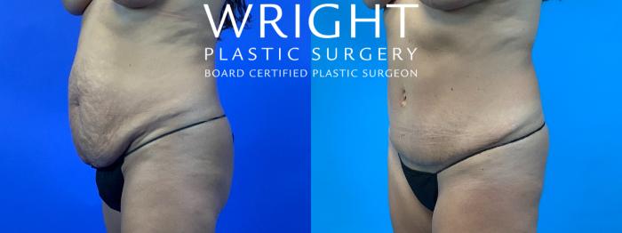 Before & After Tummy Tuck Case 196 Left Oblique View in Little Rock, Arkansas