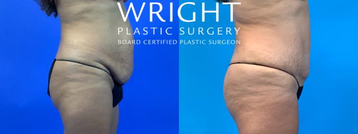 Before & After Liposuction Case 196 Right Side View in Little Rock, Arkansas