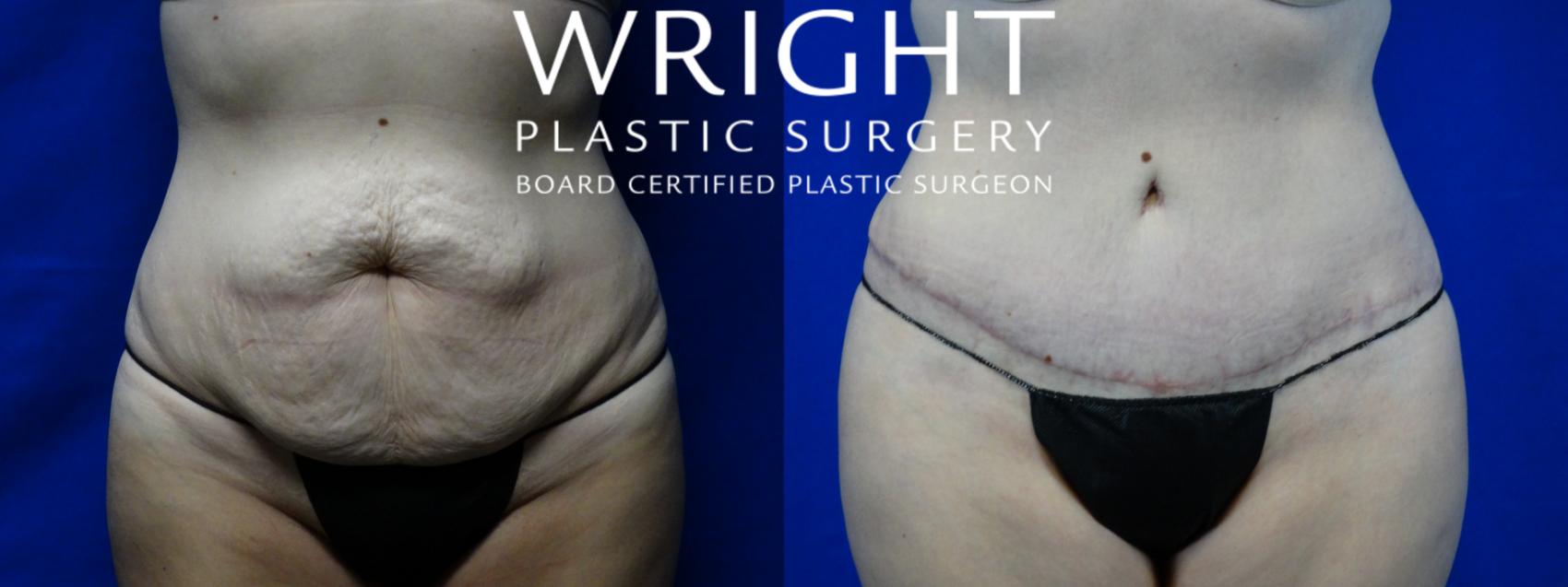 Plastic Surgery Case Study - Full Tummy Tuck and Flank Liposuction Before  Weight Loss - Explore Plastic Surgery