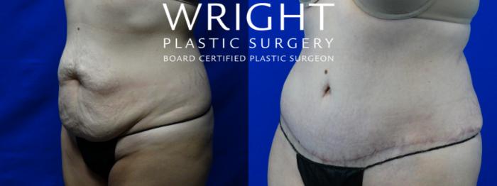 Before & After Tummy Tuck Case 2 Left Oblique View in Little Rock, Arkansas