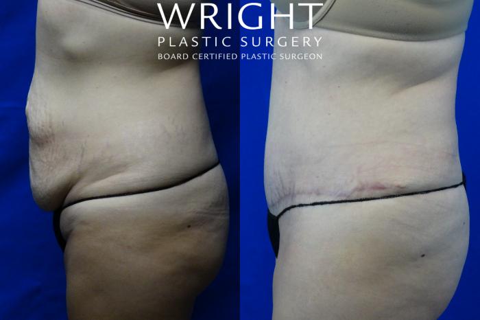 Before & After Tummy Tuck Case 2 Left Side View in Little Rock, Arkansas