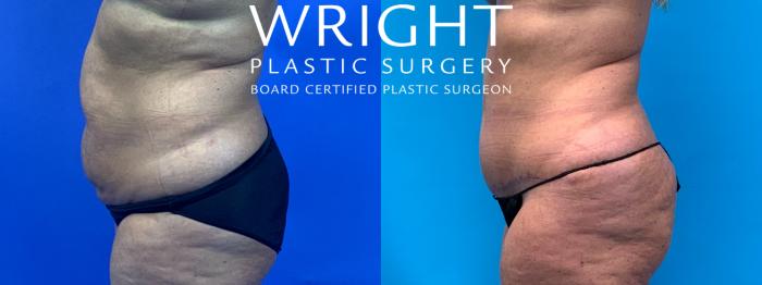 Before & After Tummy Tuck Case 203 Left Side View in Little Rock, Arkansas