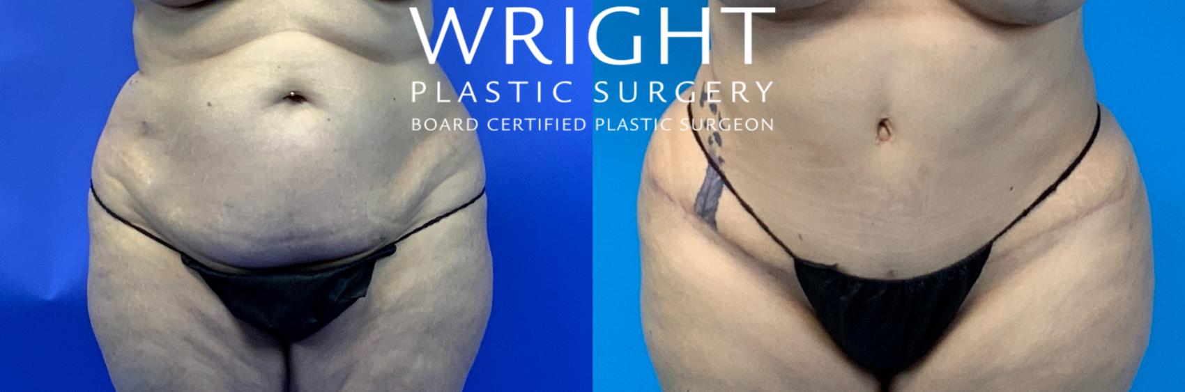 Before & After Tummy Tuck Case 207 Front View in Little Rock, Arkansas