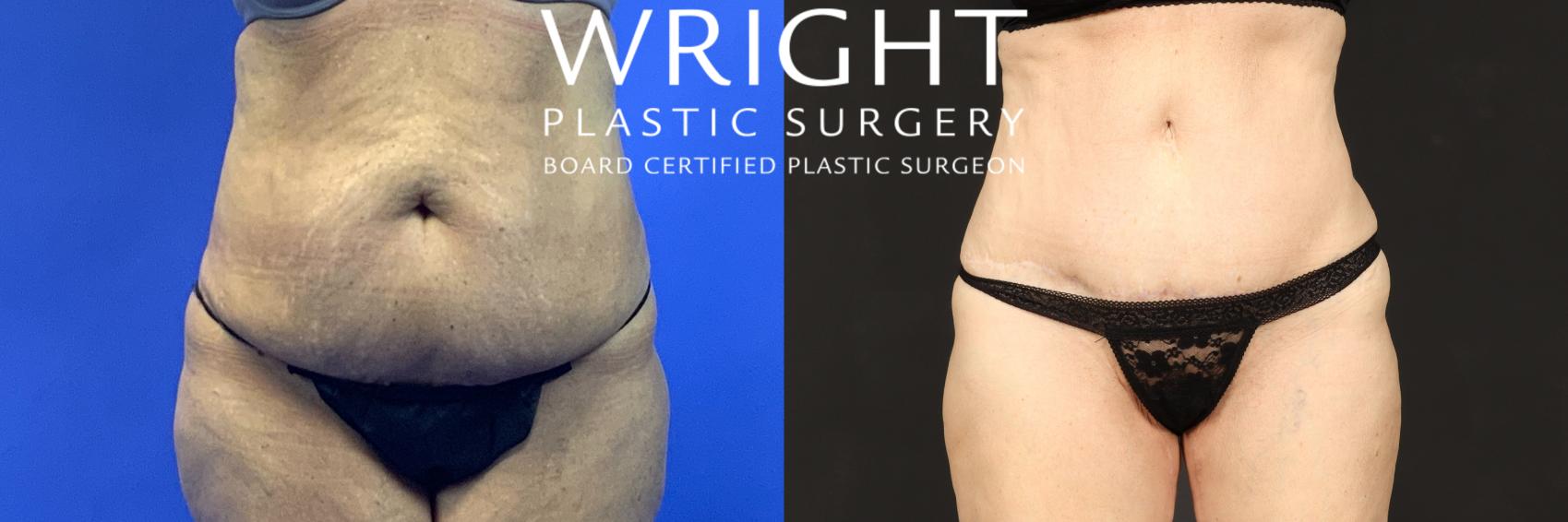 Before & After Tummy Tuck Case 215 Front View in Little Rock, Arkansas