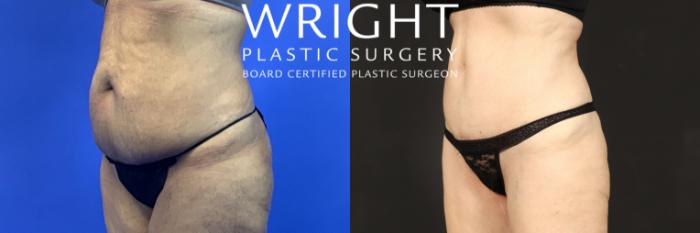 Before & After Tummy Tuck Case 215 Left Oblique View in Little Rock, Arkansas