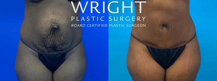 Before & After Tummy Tuck Case 240 Front View in Little Rock, Arkansas