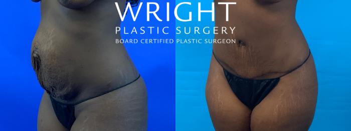 Before & After Tummy Tuck Case 240 Left Oblique View in Little Rock, Arkansas