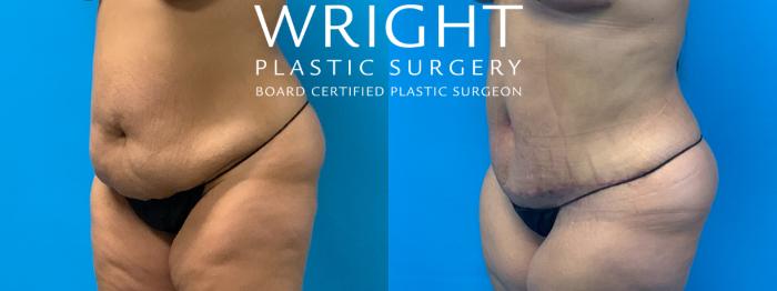 Before & After Tummy Tuck Case 244 Left Oblique View in Little Rock, Arkansas