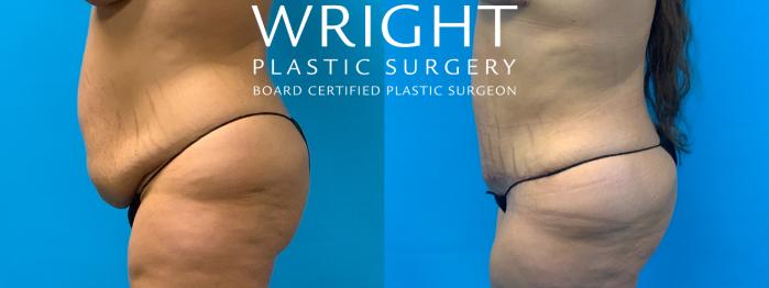 Before & After Tummy Tuck Case 244 Left Side View in Little Rock, Arkansas