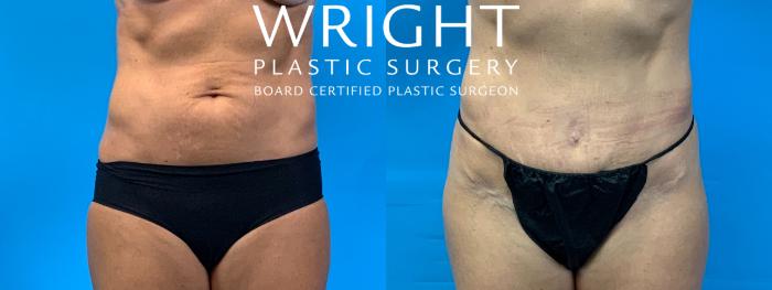 Before & After Tummy Tuck Case 262 Front View in Little Rock, Arkansas