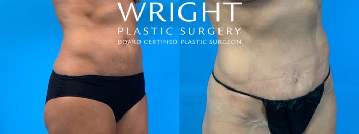 Before & After Tummy Tuck Case 262 Right Oblique View in Little Rock, Arkansas