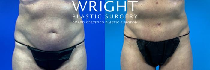 Before & After Tummy Tuck Case 274 Front View in Little Rock, Arkansas