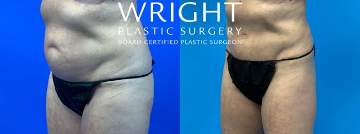 Before & After Tummy Tuck Case 274 Left Oblique View in Little Rock, Arkansas