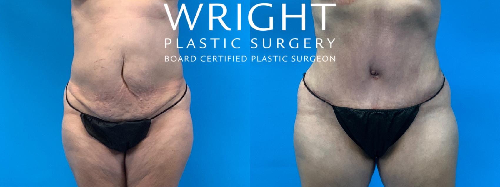 Charlottesville Plastic Surgery - ABDOMINOPLASTY WITH FASCIAL PLICATION AND  360° LIPOSUCTION This patient had long-standing severe diastasis recti and  stubborn abdominal fat & skin excess from childbirth and age. Dr. Willis  performed