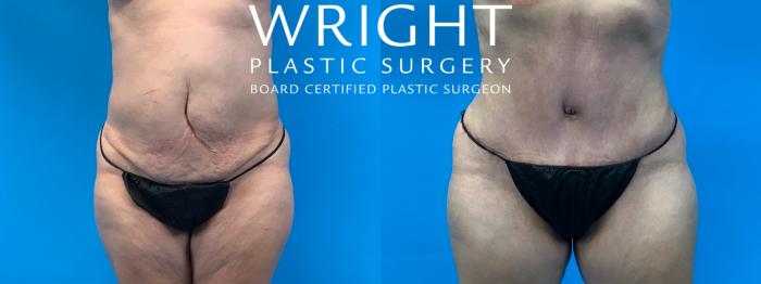 Before & After Tummy Tuck Case 281 Front View in Little Rock, Arkansas