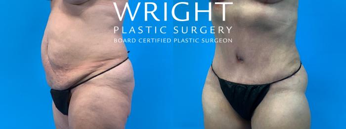 Before & After Tummy Tuck Case 281 Left Oblique View in Little Rock, Arkansas