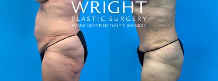Before & After Tummy Tuck Case 281 Left Side View in Little Rock, Arkansas
