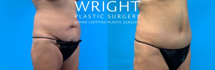 Before & After Tummy Tuck Case 288 Right Oblique View in Little Rock, Arkansas
