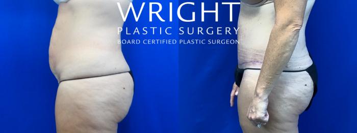 Before & After Tummy Tuck Case 29 Left Side View in Little Rock, Arkansas