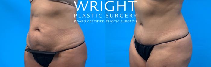 Before & After Tummy Tuck Case 292 Left Oblique View in Little Rock, Arkansas
