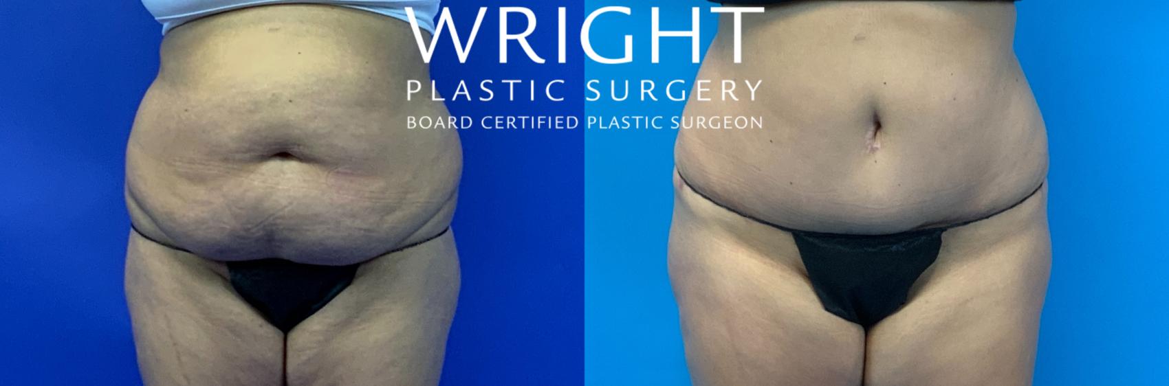 Before & After Tummy Tuck Case 300 Front View in Little Rock, Arkansas