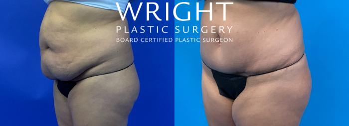 Before & After Tummy Tuck Case 300 Left Oblique View in Little Rock, Arkansas