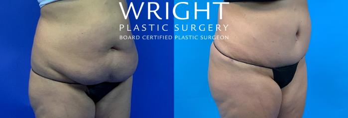 Before & After Liposuction Case 300 Right Oblique View in Little Rock, Arkansas