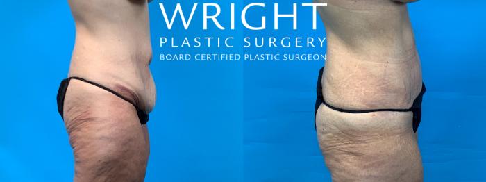 Before & After Tummy Tuck Case 305 Right Side View in Little Rock, Arkansas