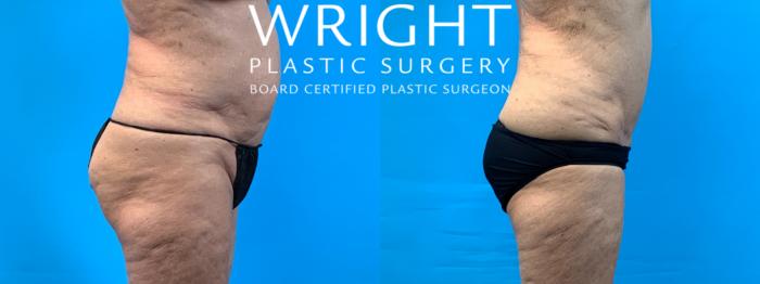 Before & After Tummy Tuck Case 307 Right Side View in Little Rock, Arkansas