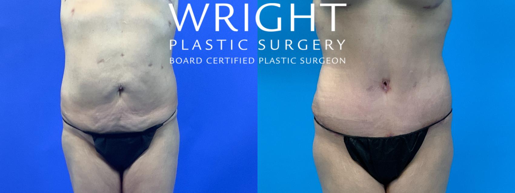 Before & After Tummy Tuck Case 318 Front View in Little Rock, Arkansas