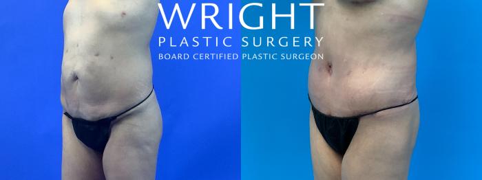 Before & After Tummy Tuck Case 318 Left Oblique View in Little Rock, Arkansas
