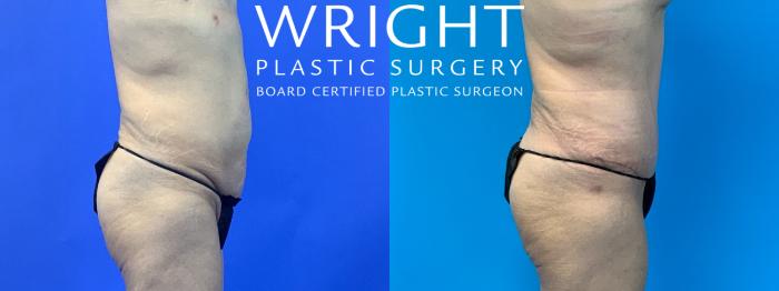 Before & After Tummy Tuck Case 318 Right Side View in Little Rock, Arkansas