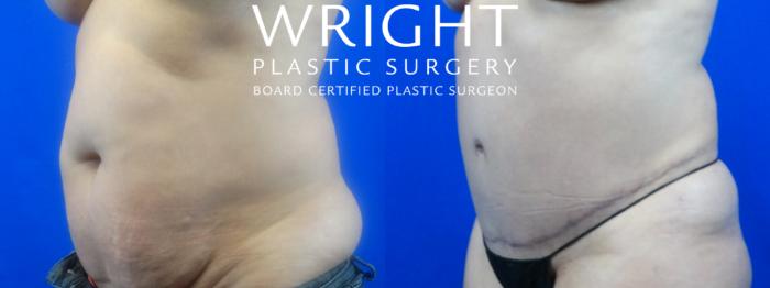 Before & After Tummy Tuck Case 32 Left Oblique View in Little Rock, Arkansas